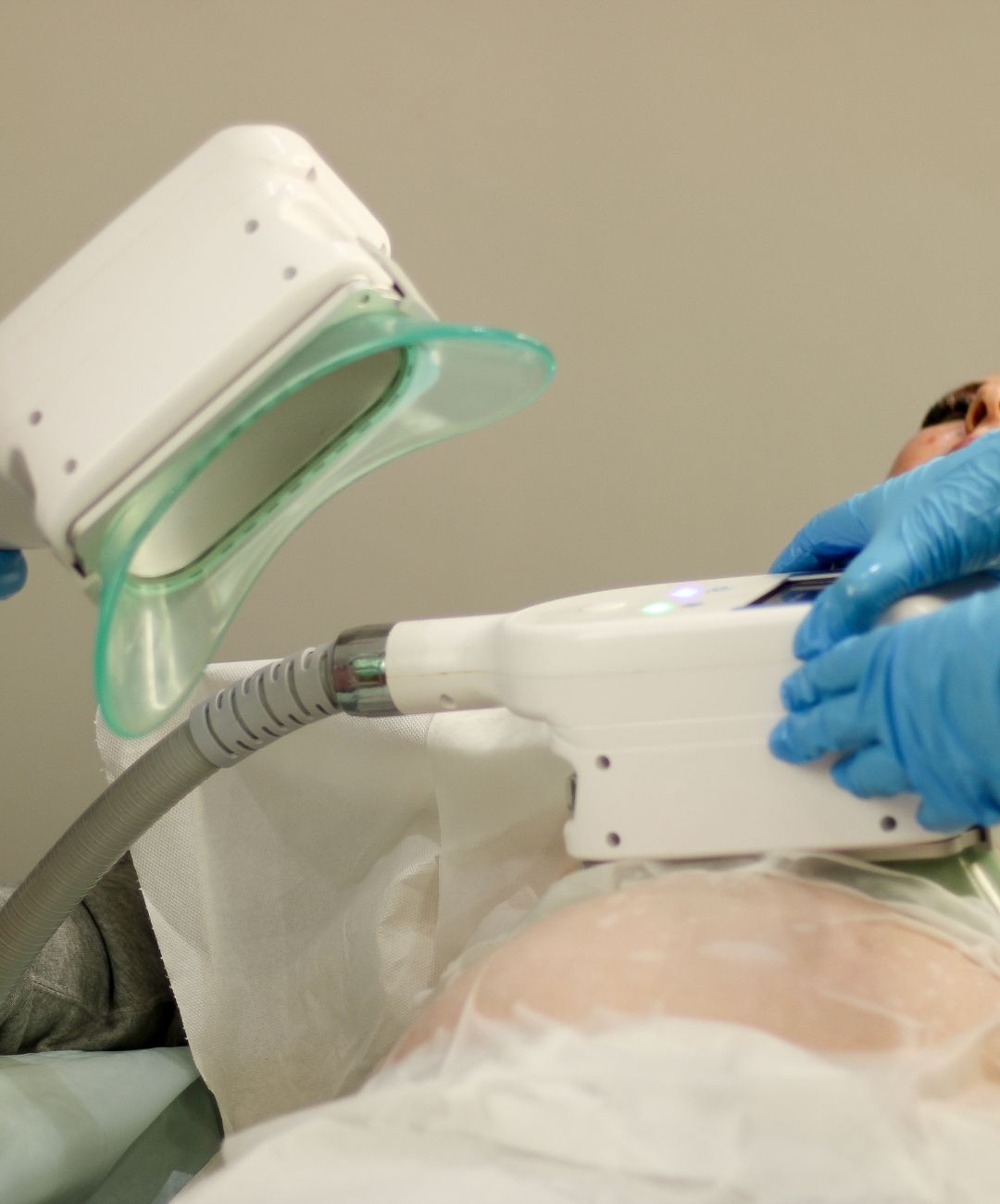 Body Sculpture Fat Freeze (Cryolipolysis)