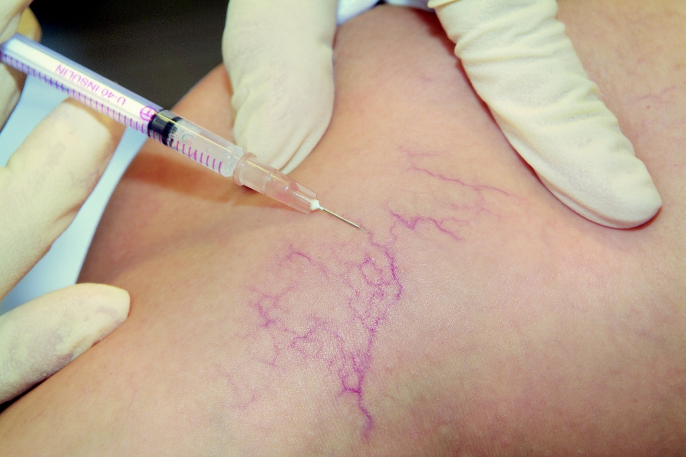 Micro-Sclerotherapy